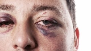 How to Treat a Black Eye  First Aid Training [upl. by Ajit]