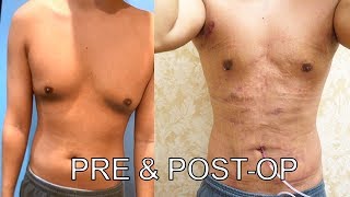 GYNECOMASTIA Surgery 48 hrs PostOP Results BEFORE AND AFTER 🔥  Dr Lebowitz [upl. by Ailalue864]