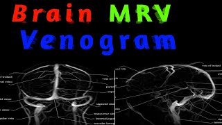 Brain MRV  Venogram  How to do BRAIN MRV  MRV planning Haryana MRI Hindi classes [upl. by Anelac]