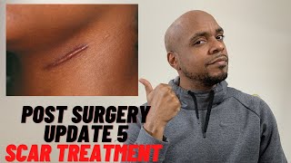 Ep 5 Post Gynecomastia Scars  Keloid Scars [upl. by Schifra]