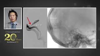 Venous Compression Syndromes From Diagnosis to Treatment [upl. by Doralynn]