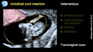 Velamentous insertion of the umbilical cord [upl. by Tallia537]