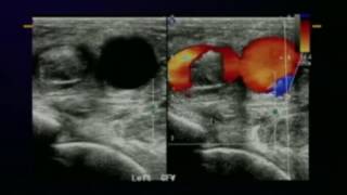 Lower Extremity Venous Protocols and Interpretation [upl. by Painter]