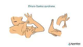 Cervical Instability in EhlersDanlos Syndrome and POTS [upl. by Ebanreb]