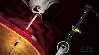 AXIOS™ Stent and Electrocautery Enhanced Delivery System Animation [upl. by Lebasile]