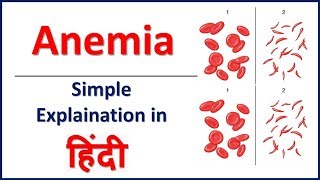 Anemia amp its types simple explaination in Hindi  Bhushan Science [upl. by Hueston]