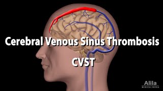 Cerebral Venous Sinus Thrombosis CVST Animation [upl. by Valiant]