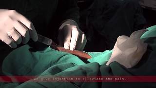 Coronary angiogram  a live demonstration [upl. by Tikna392]